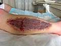 Part 2 - Brad's Surgery- The Skin Graft