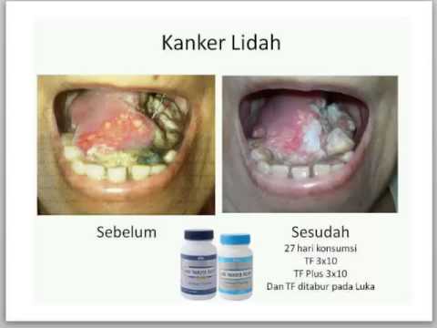 how to treat ekseem