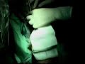 Extracci�n de la vena radial por endoscopia