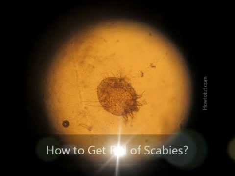 how to get rid scabies