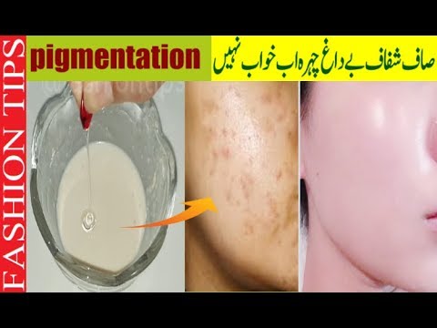 video-linktoworks-Get Rid pigmentation - Freckles, Dark Spots, Melasma,...