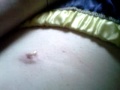 Infected . (gross)