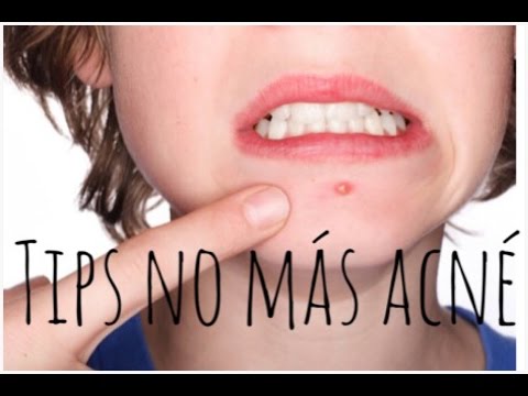 Tips: NO MAS ACNE