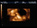 Baby Liam 3D/4D Ultrasound - 24 weeks (part 4)