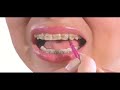 FLOSSING WITH BRACES