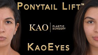 Amazing Facelift Results 12 Days After Surgery! Ponytail Lift™ by Kao Plastic Surgery