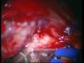 Clipping of posterior communicating artery aneurysm