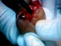 CYST DERMOID
