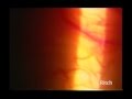 Laser Ropey Vessels (LRV)