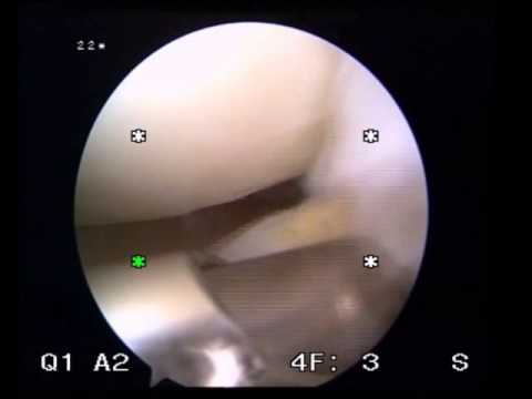 how to tell if meniscus repair is successful