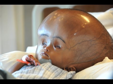Hope - Swollen Head Baby: New Hope For for Child with Large Swollen Head SUBSCRIBE: http://bit.ly/Oc61Hj BRAVE 18-month-old baby girl whose head swelled to THREE ti...