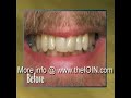 Cosmetic Dental Reconstruction Cosmetic Dental Reconstruction