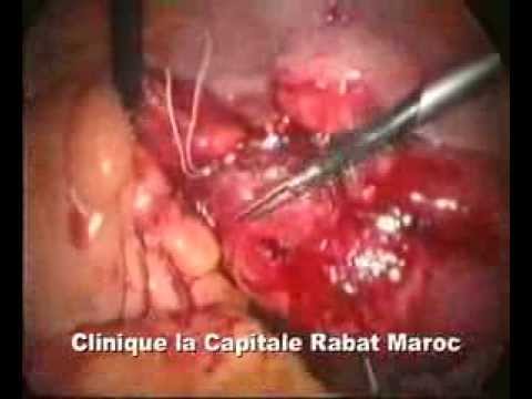 how to treat iud infection