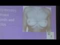 Breast Augmentation Expectation By Dr. Tarick Smaili