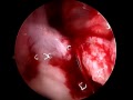 ACL surgery 4/6
