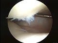 Arthroscopic Knee Surgery 5/9/08 Arthroscopic Knee Surgery 5/9/08