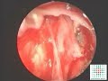 endoscope-assisted retrosigmoid approach