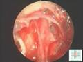 videos de endoscope-assisted retrosigmoid approach