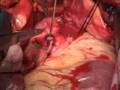 beating heart surgery Clampless top end using obturator