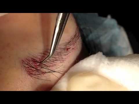 how to transplant eyebrows