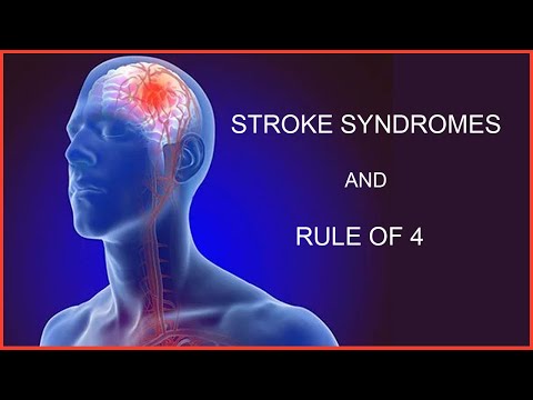 STROKE SYNDROMES AND RULE OF 4