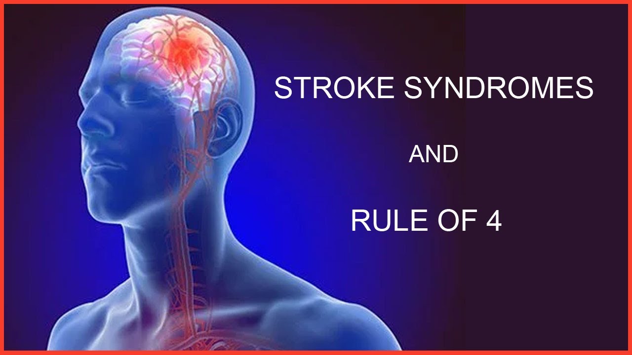 STROKE SYNDROMES AND RULE OF 4