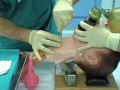 Cricotireotomia - cricothyrotomy Cricotireotomia - cricothyrotomy
