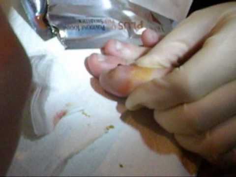 how to drain finger infection