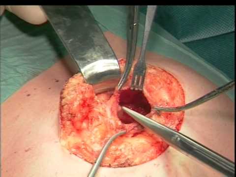 how to repair umbilical hernia