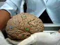 aula de  neurologia  parte 3