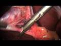 Laparoscopic Cholecystectomy