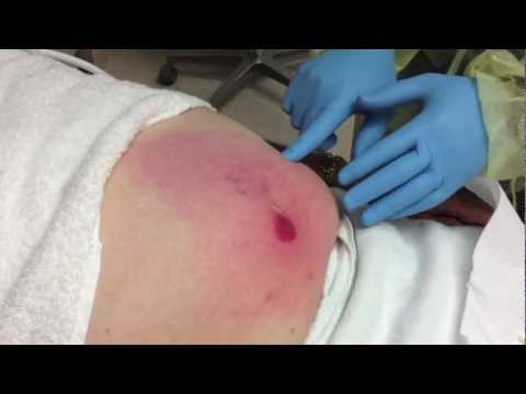 how to drain cellulitis