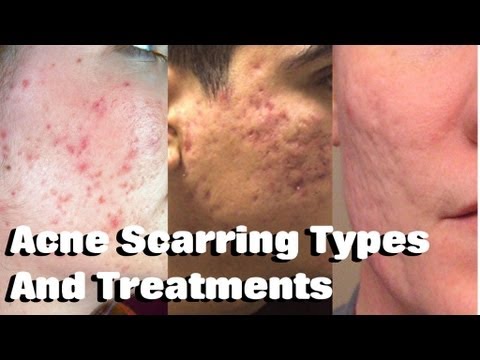 how to treat zit scars