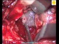 Neurosurgery Video Brain Stem Glioma