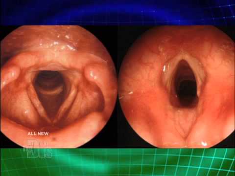 how to relieve hoarseness