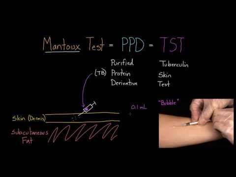 how to read a tb skin test