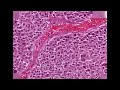 Histopathology Adrenal--Adrenocortical carcinoma