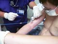 Picc Line Removal