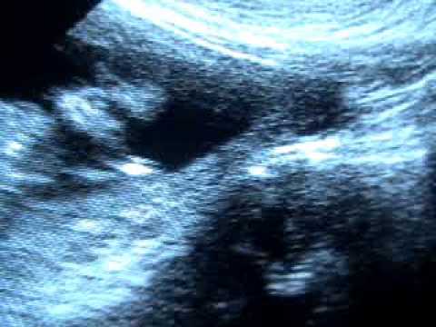 how to measure nt in ultrasound