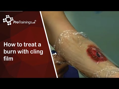how to treat tca burn