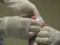 videos de Removal of surgical pins from my toes