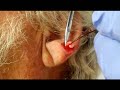 Earlobe cyst removal 8-14-2012