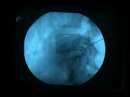 sciatica disc surgery  Sciatica Surgery