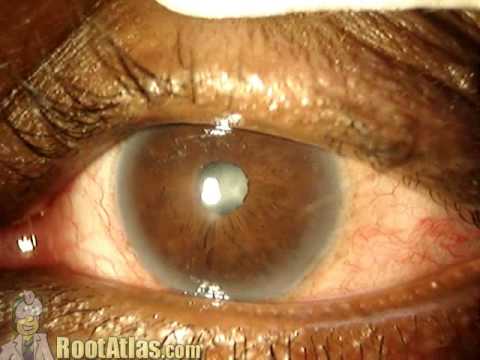 how to unclog oil glands in eyes
