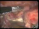 Laparoscopic Hysterectomy - Bloodless: LAVH Laparoscopic Hysterectomy - Bloodless: LAVH