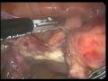 Uterus Removal Laparoscopic Intervention