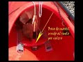 http://illajsa-mixtli.blogspot.com/2008/06/kayak-con-vela-latina-auxiliar-usando.html




con vela latina tradicional........muy interesante por su historia, y detalles de manejo, demasiado complicado para un kayak, y peligrosa si se vuelca no se puede hacer esquimotage, pero la mar de entretenida. se monta y desmonta mas o menos en 5 minutos, los materiales son de fortuna, trozos de tubo de aluminio, palo de limpia piscinas, pinzas de pl�stico, cortina de nailon de ba�o, etc...si no hay viento, ideal como sombra en verano como se ve en el v�deo.
 

illajsa