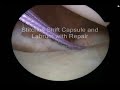 Arthroscopic Bankart Repair