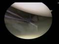 Arthroscopic Bankart Repair