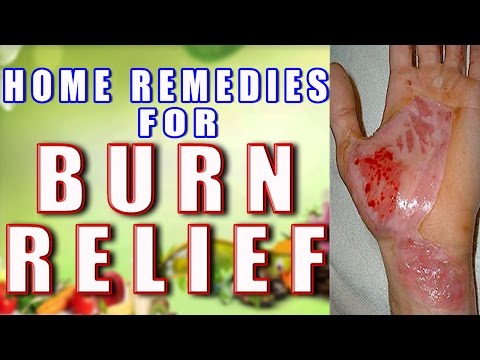 how to relieve burns